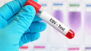Lab test bottle labeled EBV test as part of functional medicine for Epstein Barr Virus
